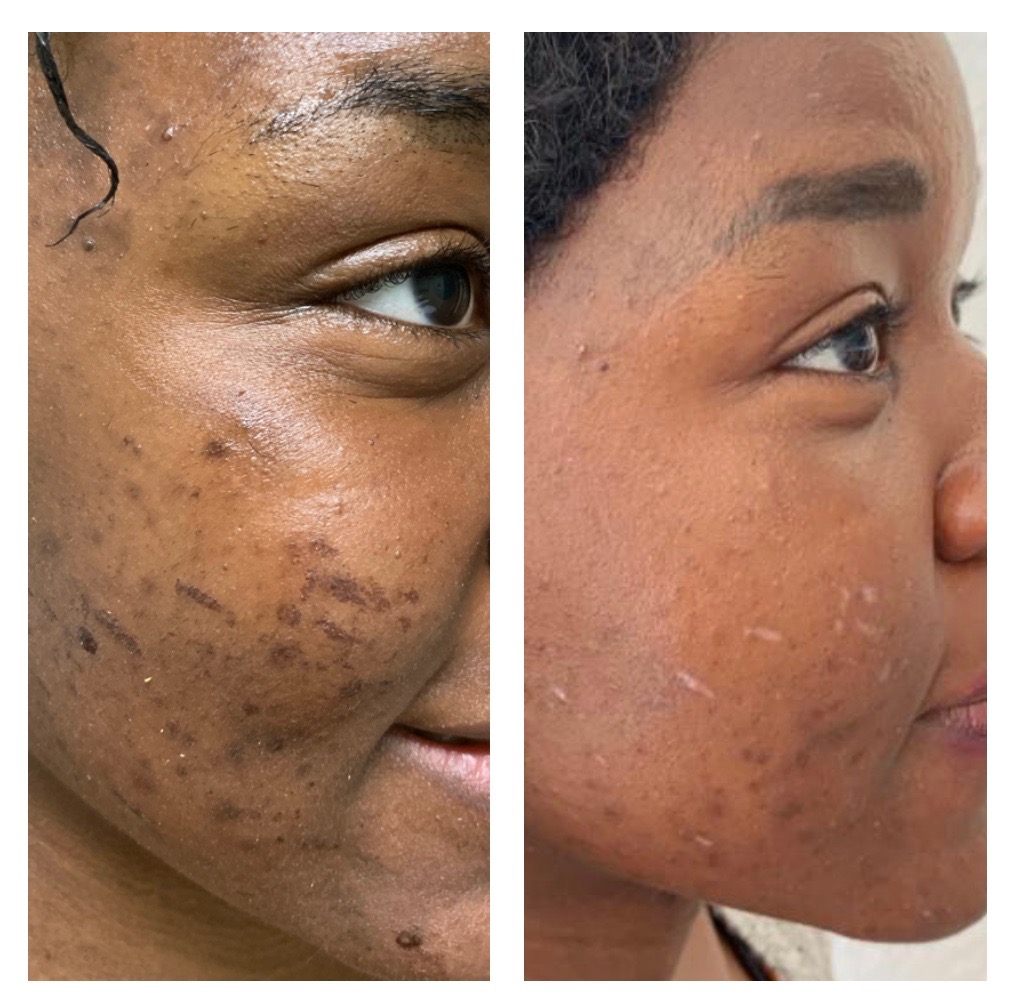 Raleigh Acne Treatment - acne scar treatment, Result Guaranteed, Acne